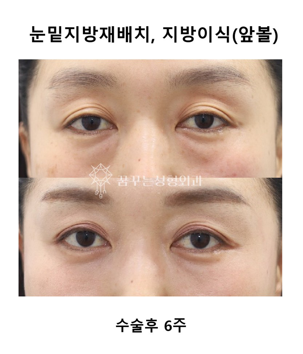 จัดเรียงไขมันใต้ตาและเติมไขมันหน้าแก้ม ก่อนผ่าตัดและหลังผ่าตัด 6 สัปดาห์